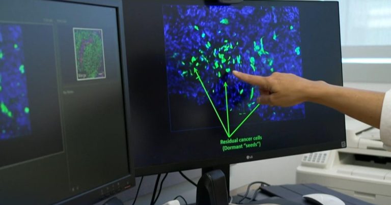 Scientists seek to wipe out breast cancer’s “sleeper cells”