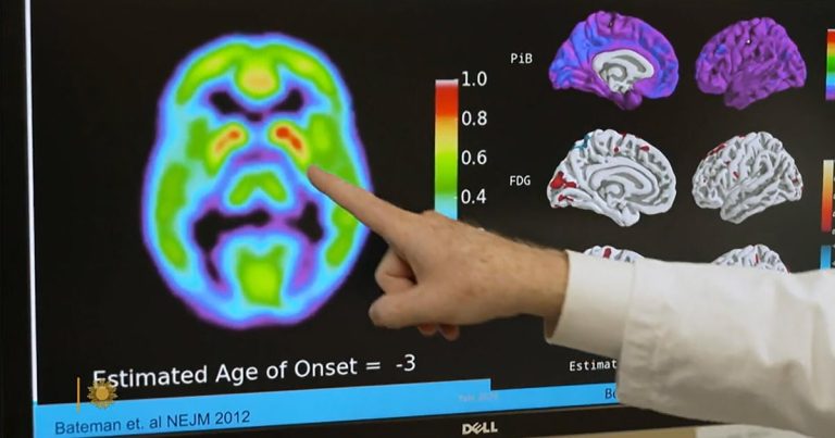 Promising clinical trials in Alzheimer’s prevention